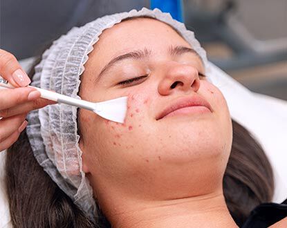 Peeling Químico 