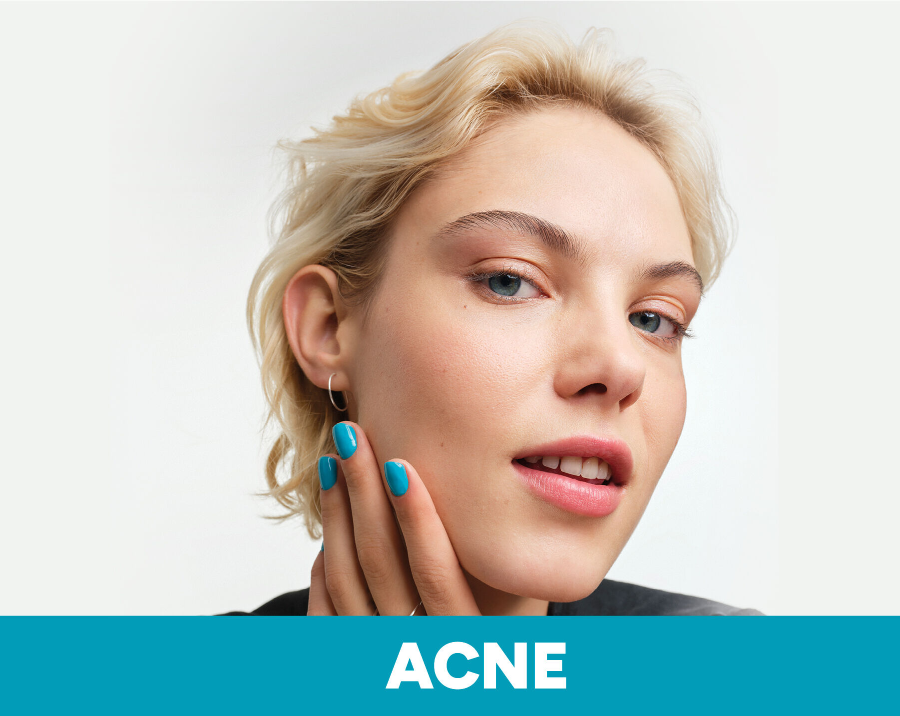 Acne.