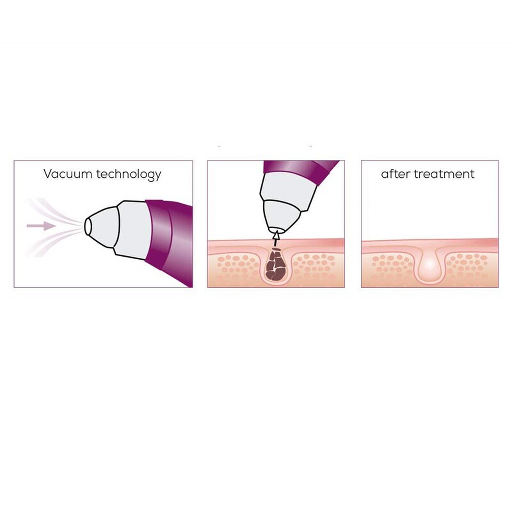 Aparelho Limpeza Poros FC41