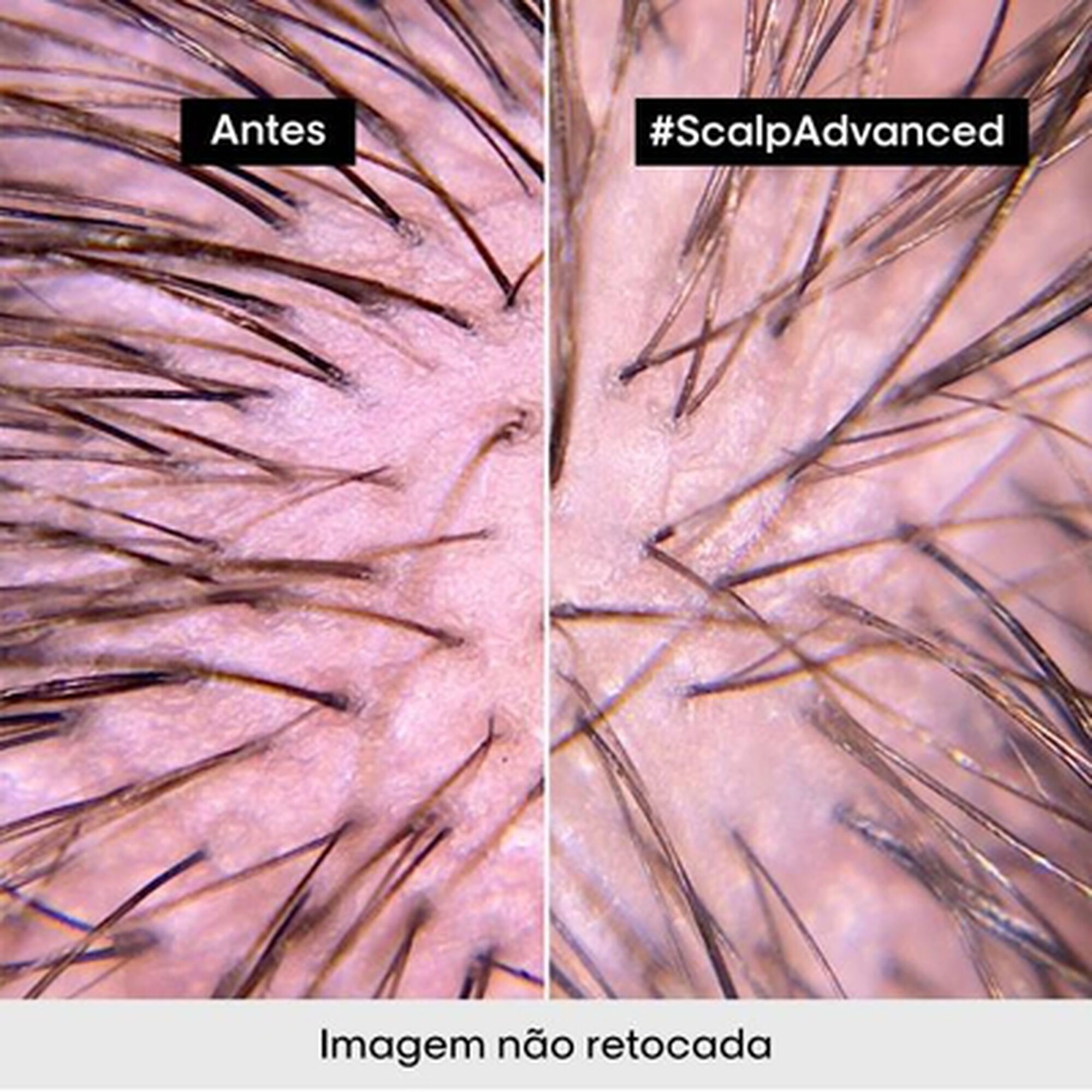 Serie Expert Scalp Advanced Inconfort Traitement