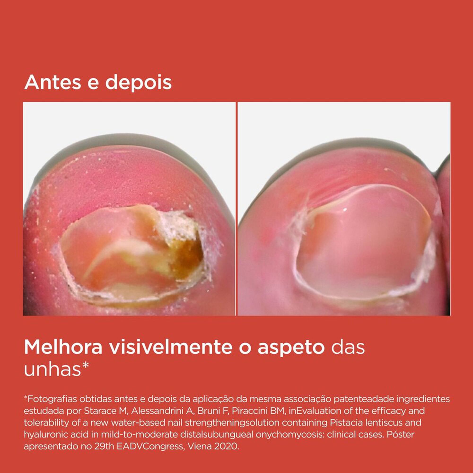 Tratamento Fungos Unhas Si-Nails MicoXpert MD
