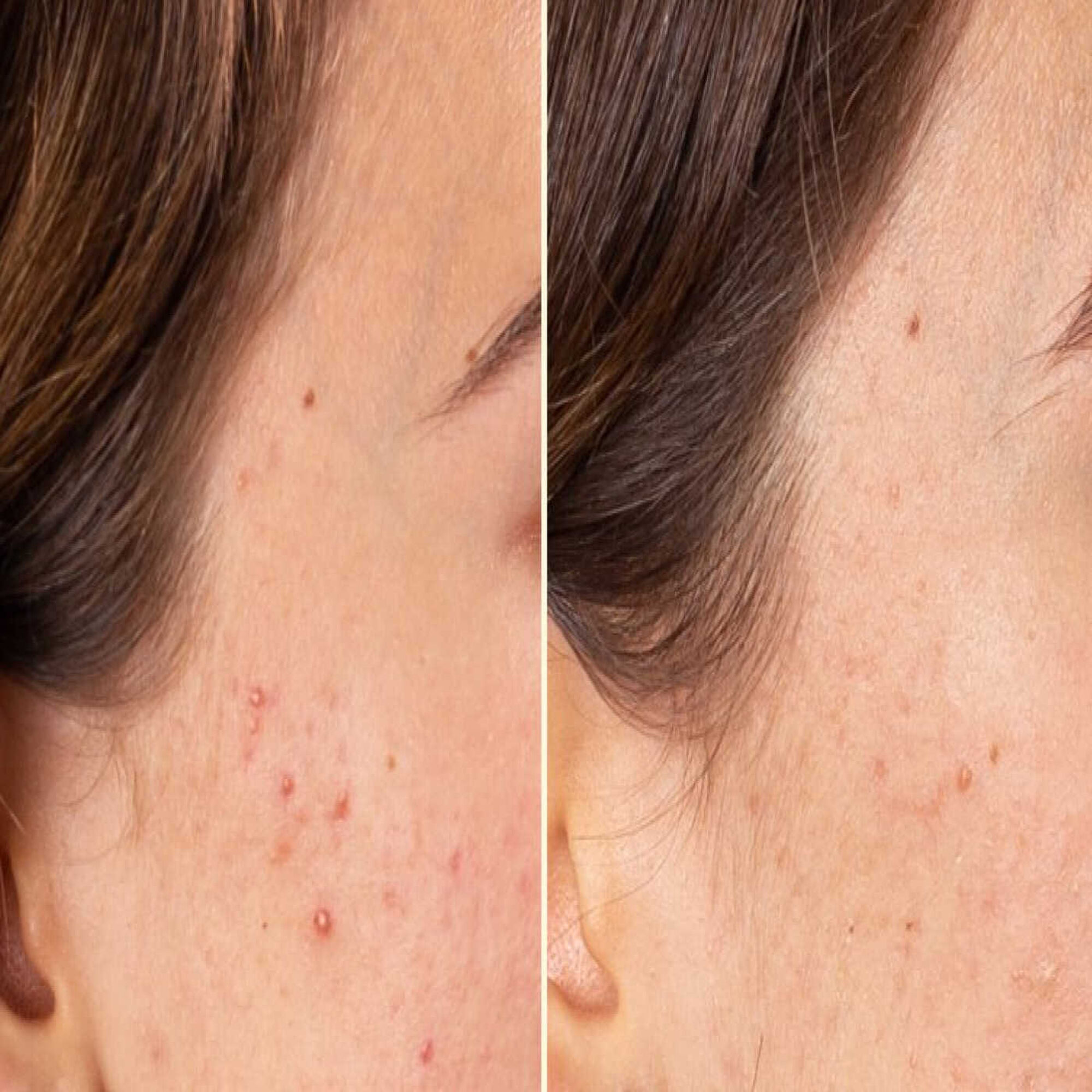 Azelaic Radiance Treatment