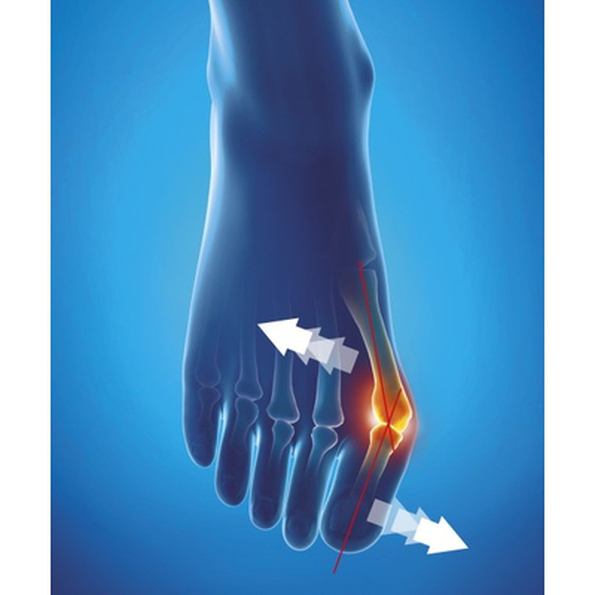 Correção de Joanetes Noturna Epitact Tam. L