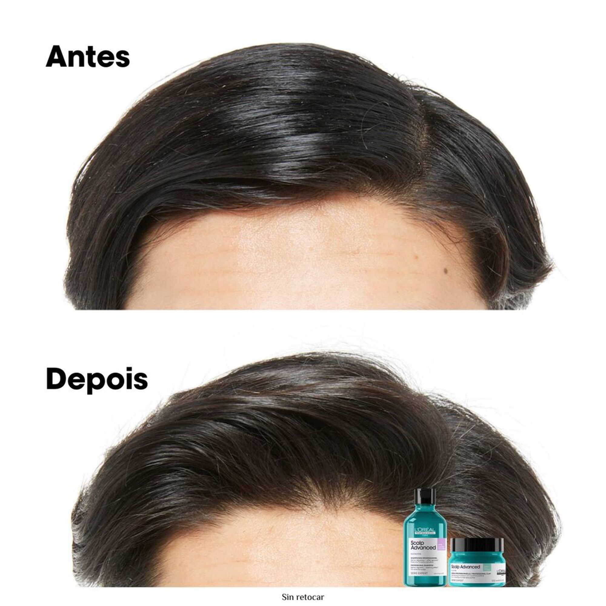 Serie Expert Scalp Advanced Anti-Gras Shampoo